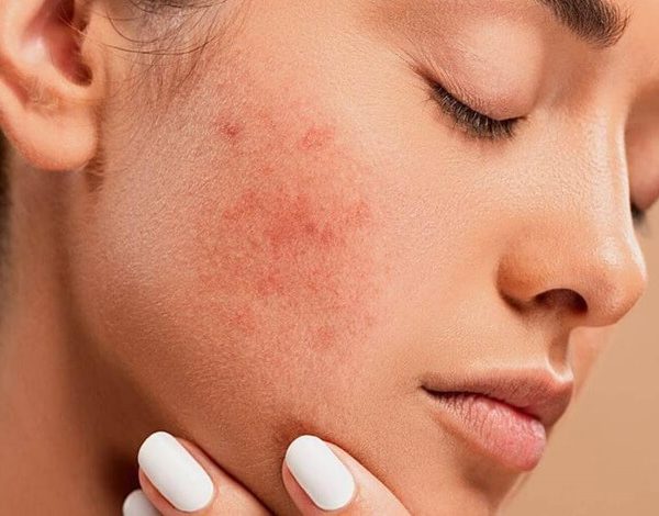 آکنه و جوش صورت چگونه ایجاد می‌شود؟