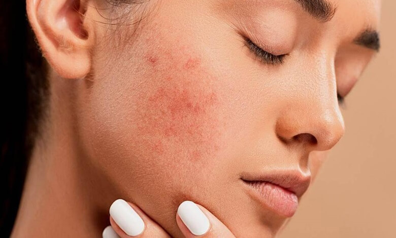 آکنه و جوش صورت چگونه ایجاد میشود؟