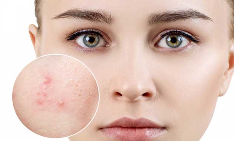 علائم ایجاد آکنه چیست؟