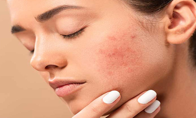 مراقبت های پس از سابسیژن