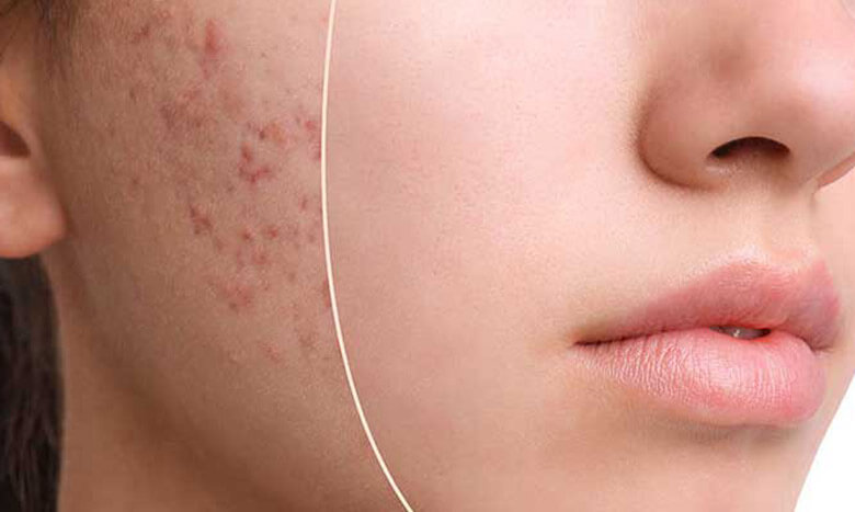 مراقبتهای قبل و بعد از لیزر سی او تو چیست؟